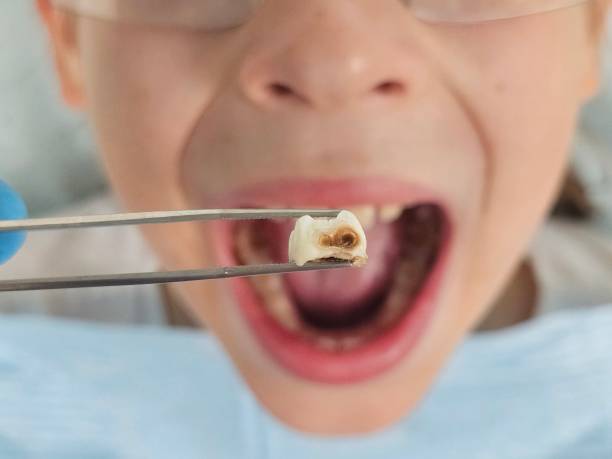 Best Emergency Dentist for Lost Fillings or Crowns in Rockford, MI